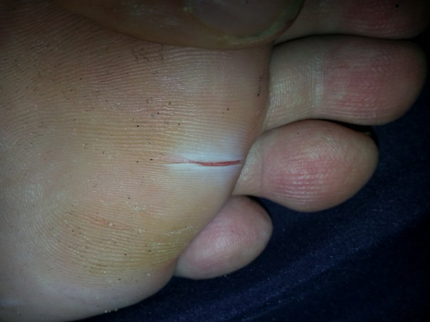It literally pulled a sliver of callus out all the way down!